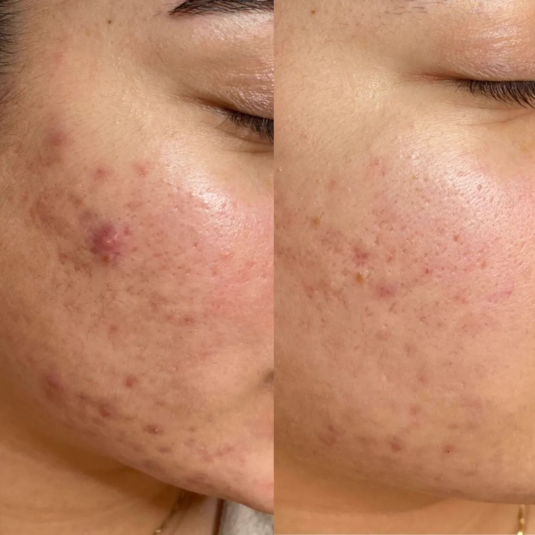 Before and after acne on the cheek after medical facials