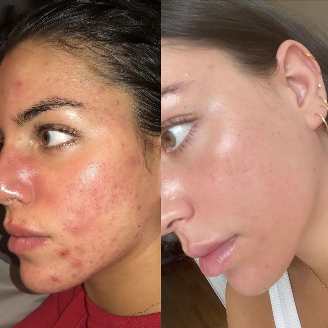 Before and after inflamed acne clearing on the cheek