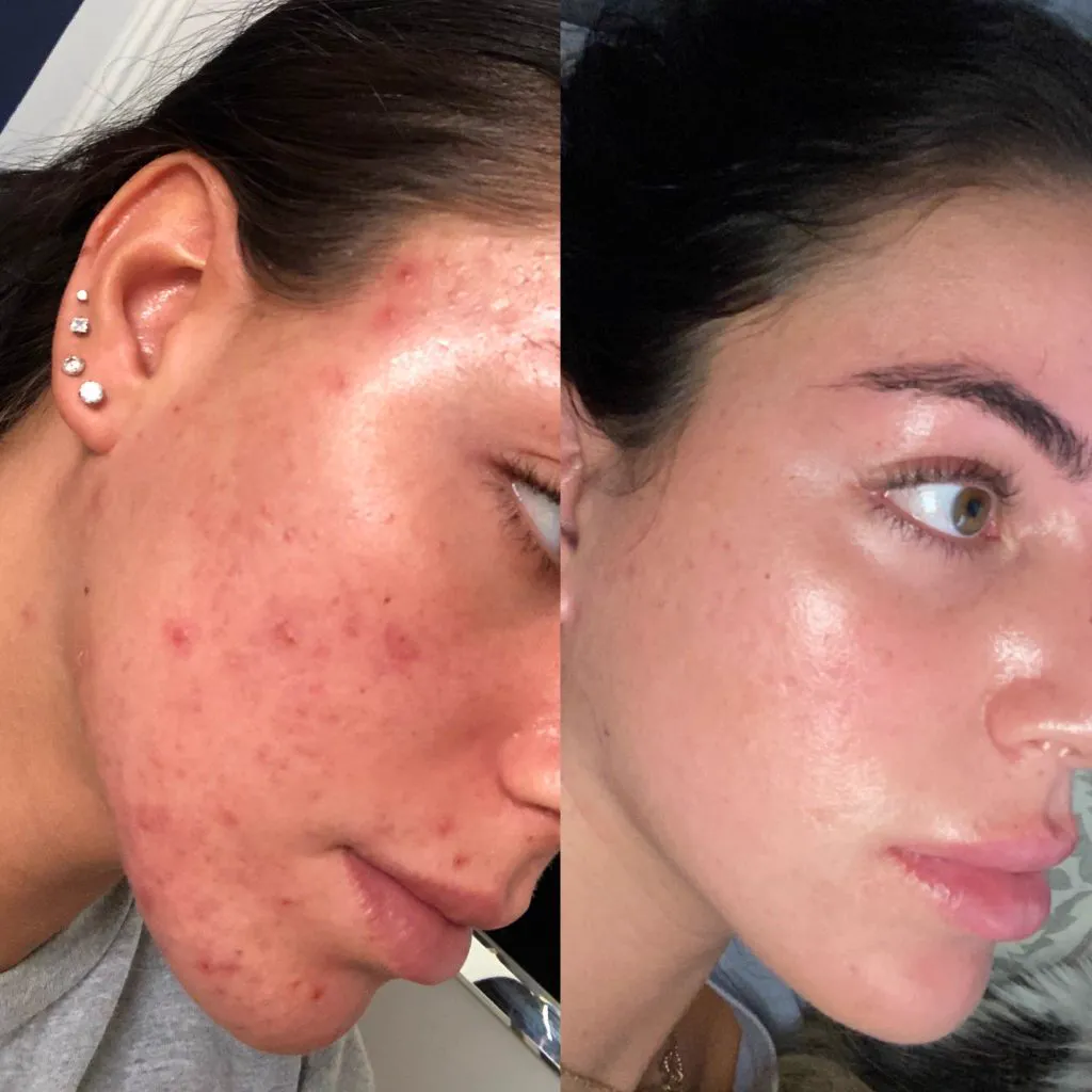 Before and after acne clearing, side profile