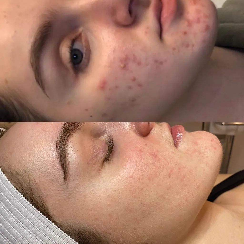 Before and after full-face acne improvement