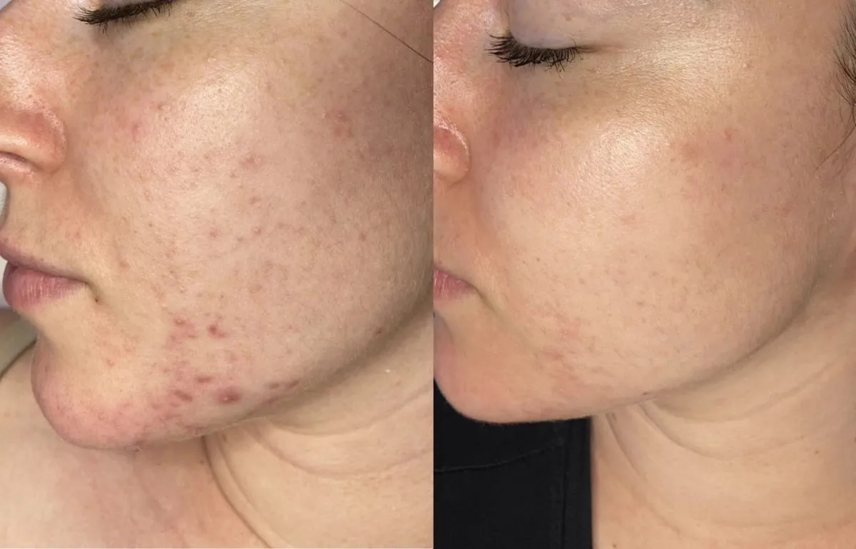 Before and after acne clearing on the cheek with medical facials in Vaughan