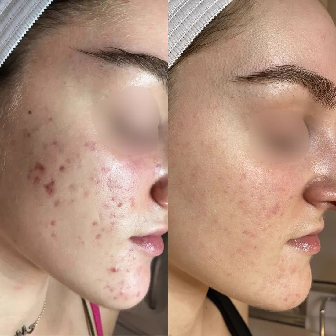Before and after acne on the full cheek