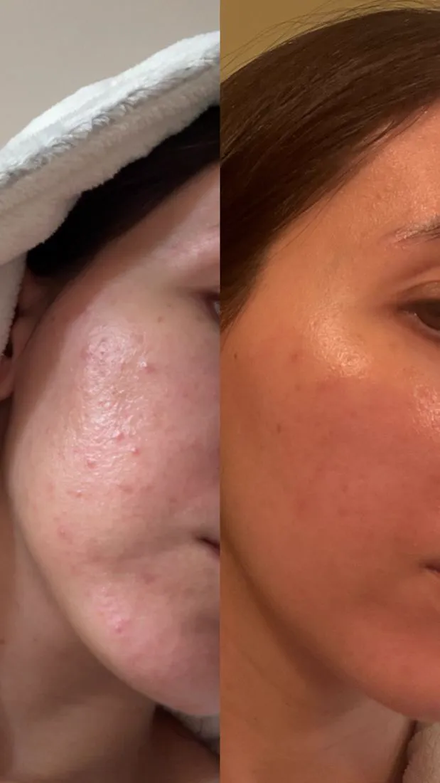 Before and after acne with improved glow