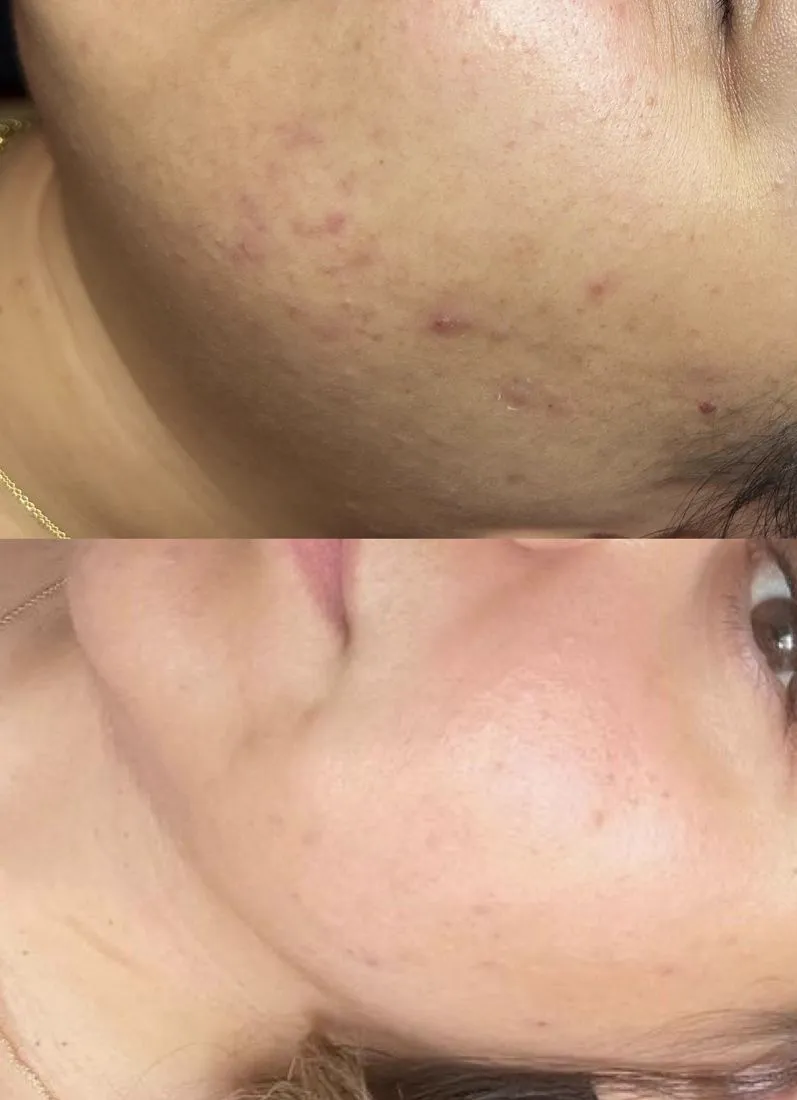 Before and after acne along the jawline