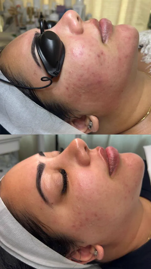 Before and after acne with LED light therapy