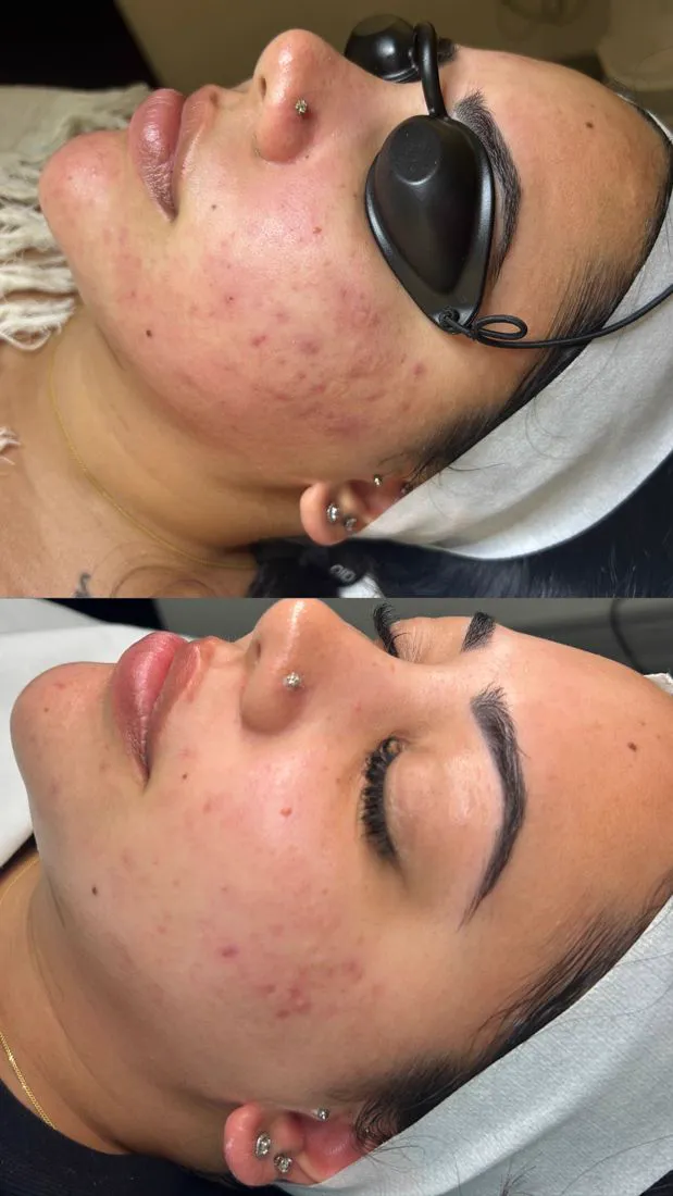 Before and after acne during LED light therapy