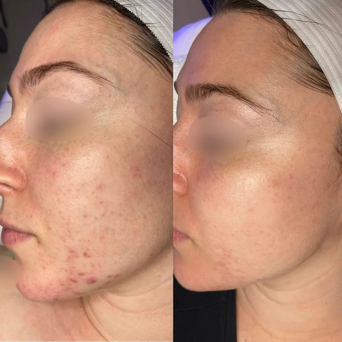 Before and after acne, profile view