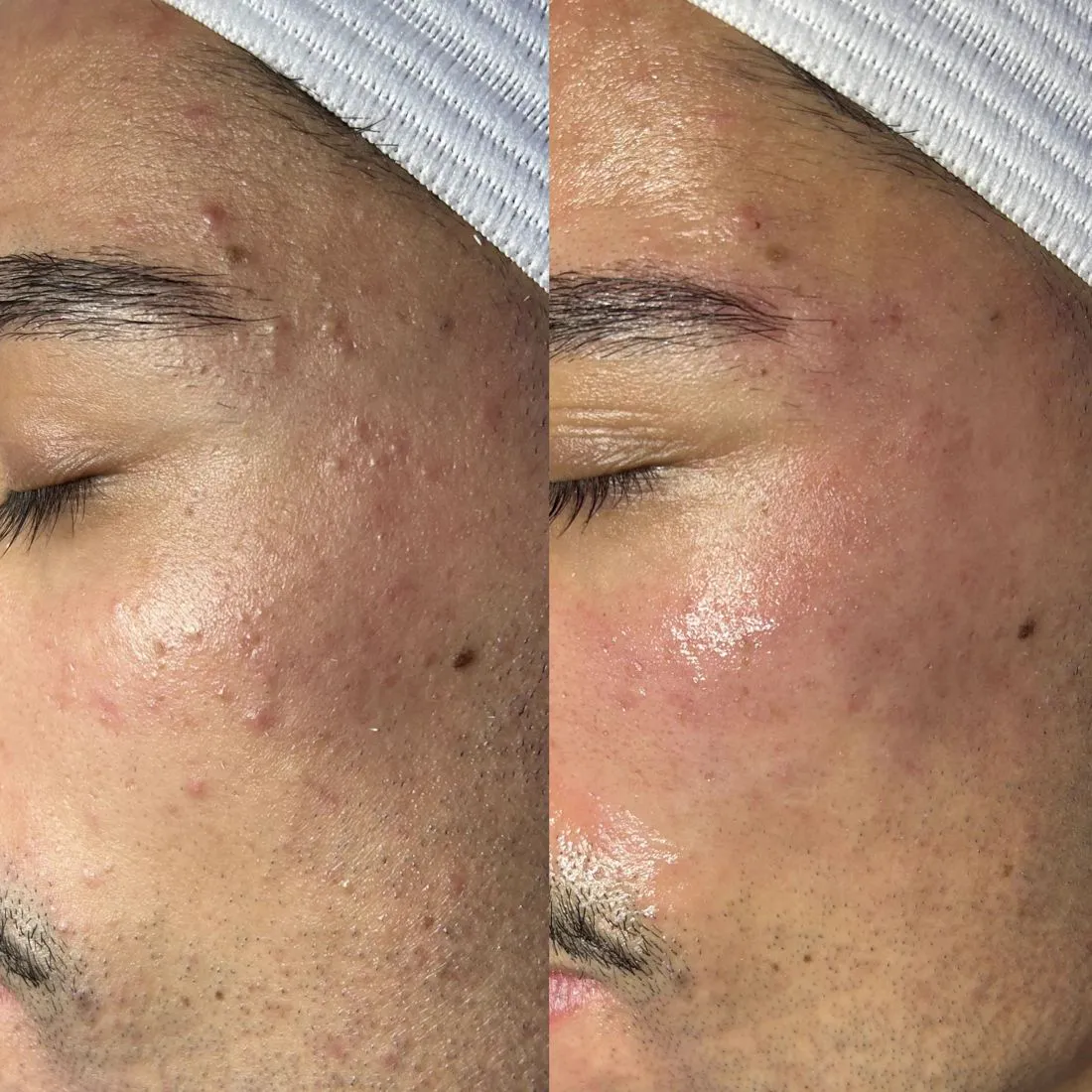Before and after acne and texture on the forehead and cheek