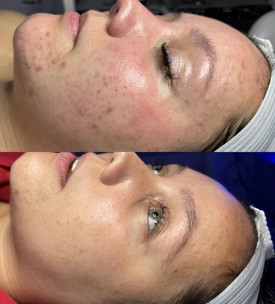 Before and after acne and texture improvement