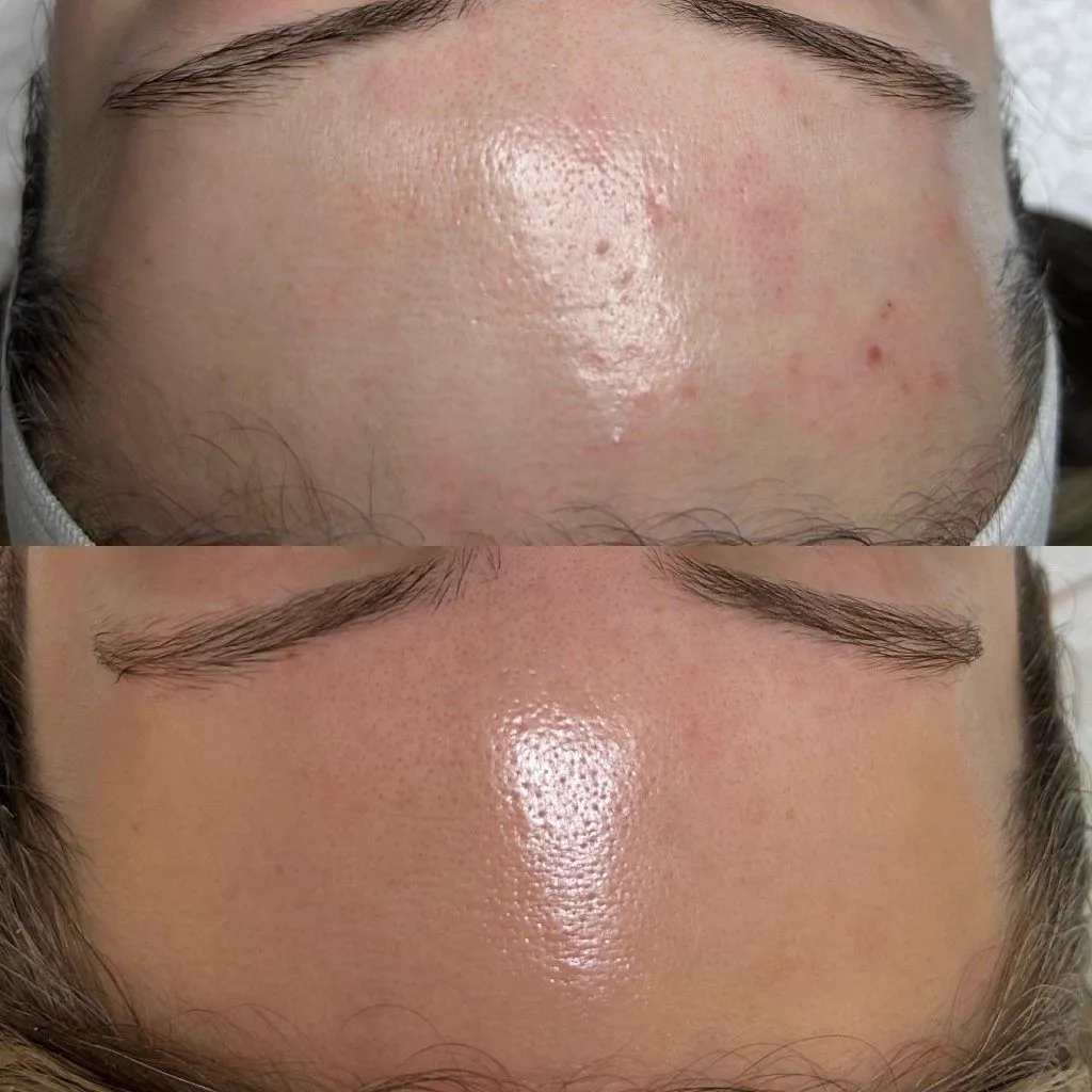 Enlarged Pores & Texture treatment at Balanced Beauty Med Spa, Vaughan