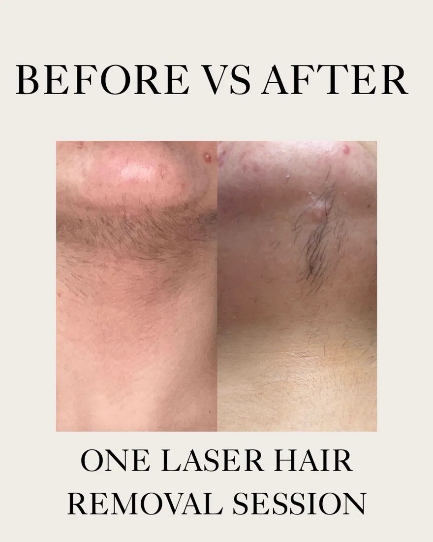 Laser hair removal before and after one session