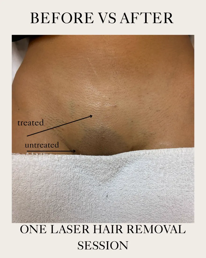 Laser hair removal treated versus untreated area after one session