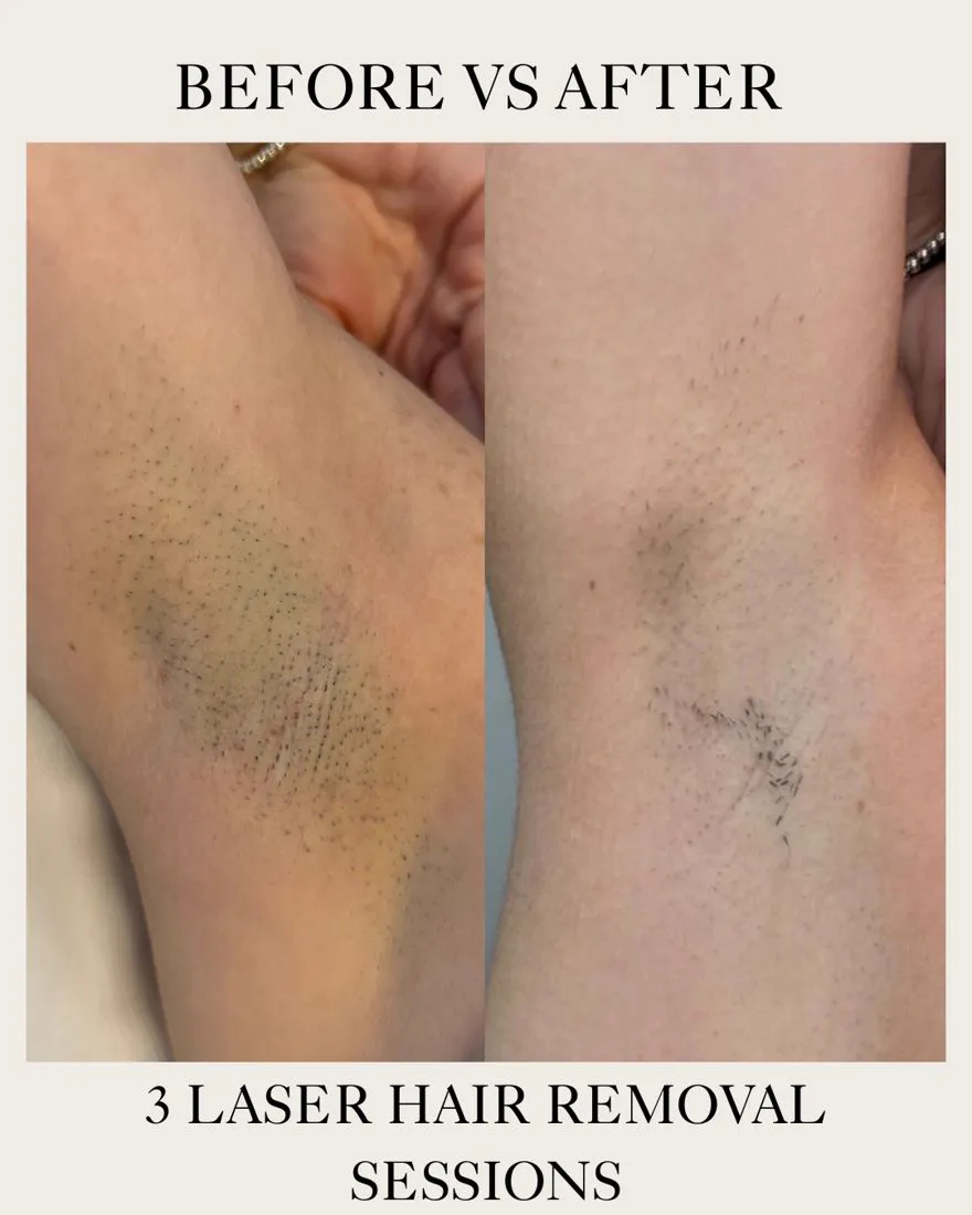 Underarm laser hair removal before and after three sessions