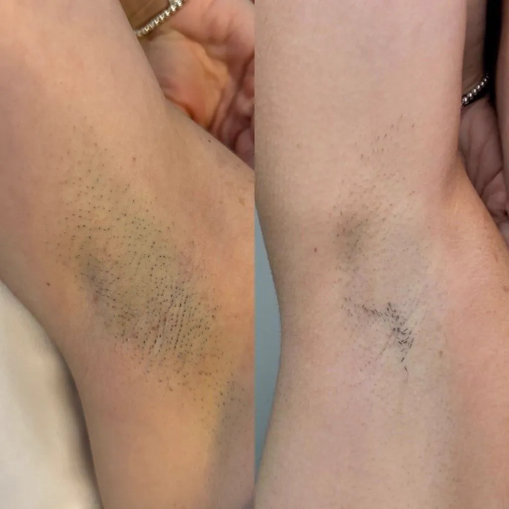 Unwanted Hair treatment at Balanced Beauty Med Spa, Vaughan