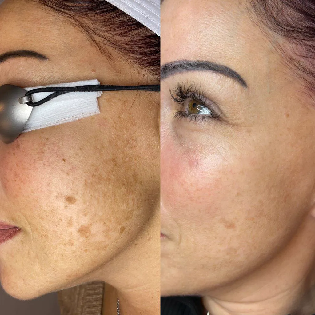 Before and after pigmentation improvement on the cheek