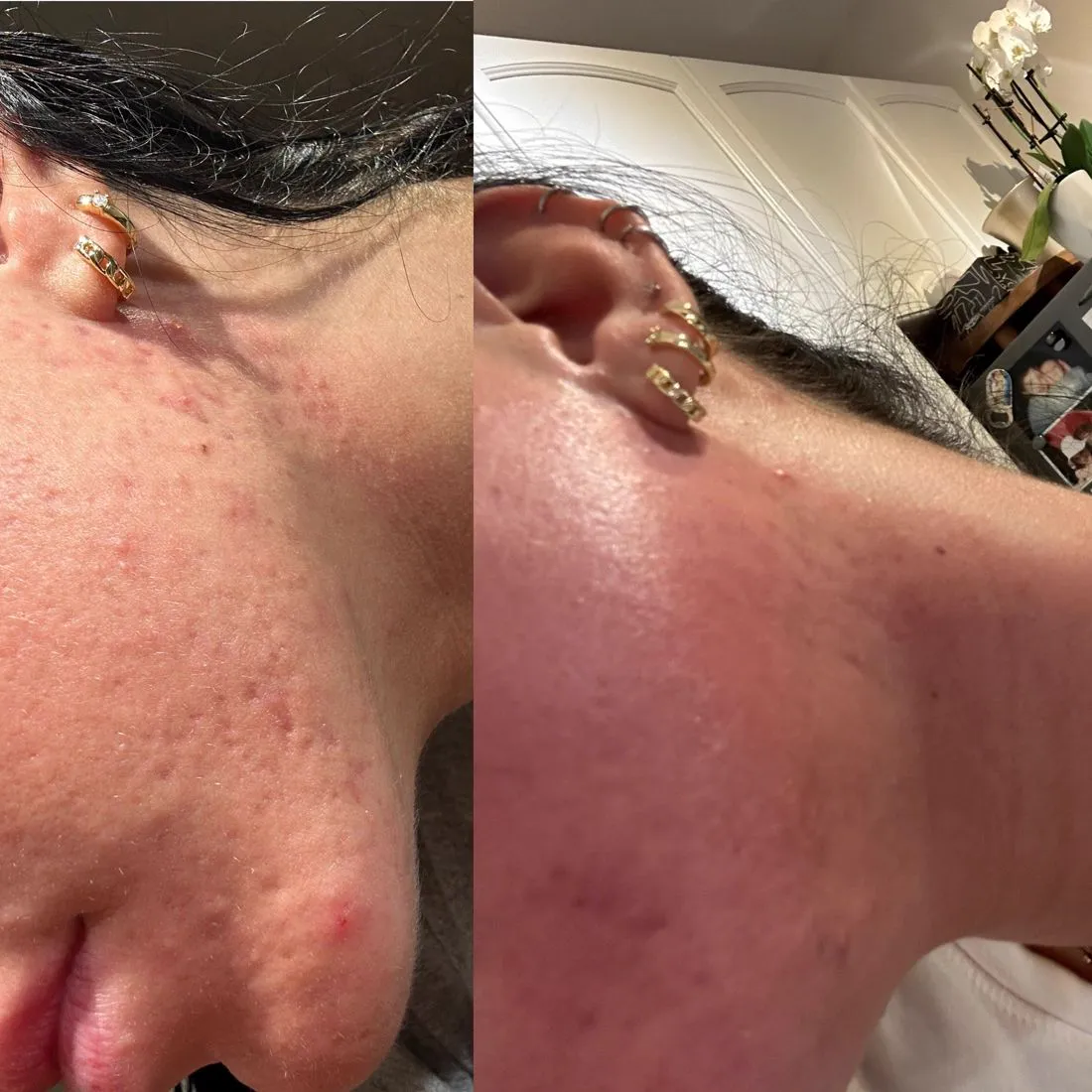 Sensitive or Reactive Skin treatment at Balanced Beauty Med Spa, Vaughan