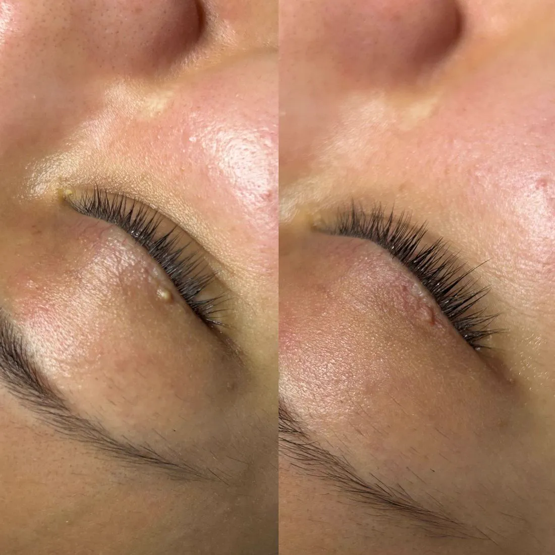 Before and after skin texture around the eye area