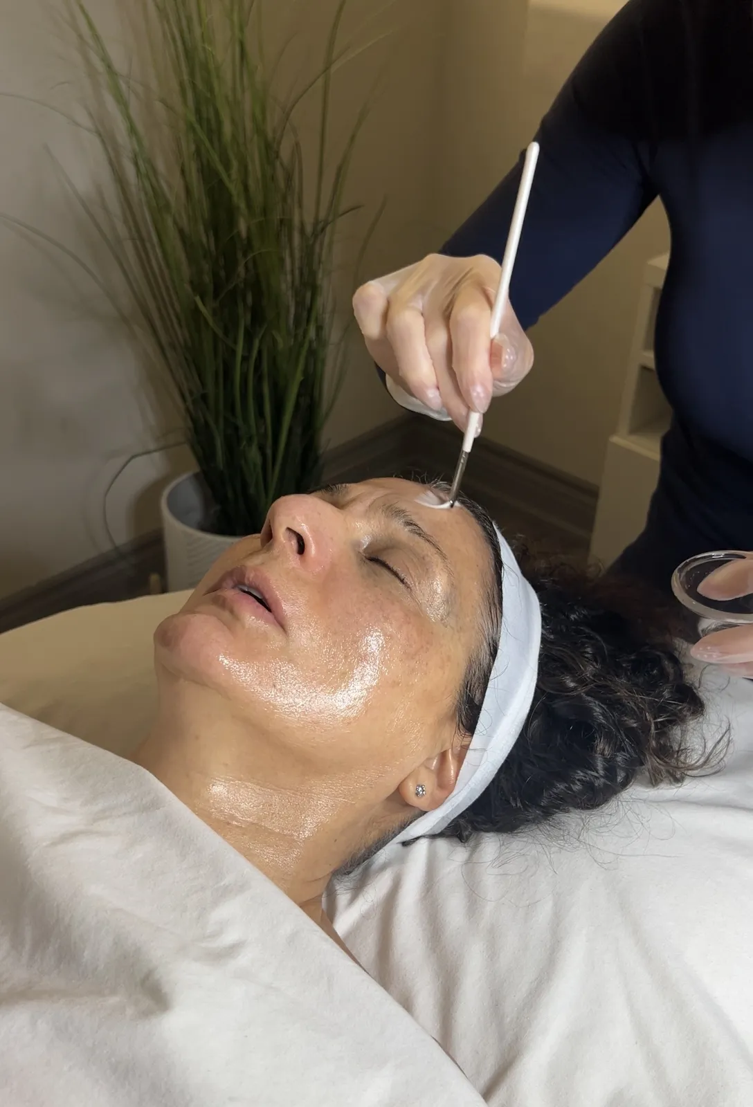 Salicylic Acid Peel (20% or 25%) at Balanced Beauty Med Spa in Vaughan
