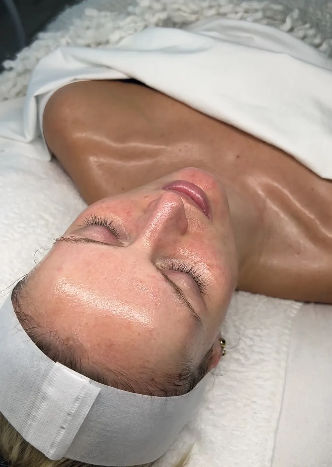 TCA Peel (13%) at Balanced Beauty Med Spa in Vaughan
